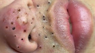 Blackhead Treatment At Loan Nguyen Spa  23 [upl. by Sibilla]