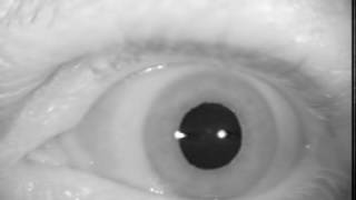 Uncompensated Left Weakness with 2nd Degree Gaze Nystagmus [upl. by Iffar]