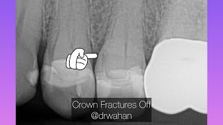 Premolar Extraction after Crown Fracture Using Rongeurs [upl. by Mirak697]