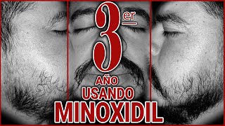 TRES AÑOS USANDO MINOXIDIL [upl. by Ahsenad]