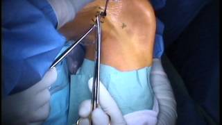 ITB Release Surgery [upl. by Fielding]