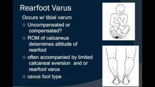 Rearfoot Varus [upl. by Radke449]