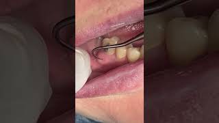 Dental abscess satisfying [upl. by Yeruoc]