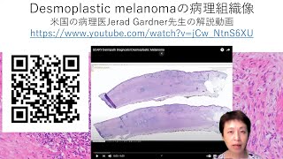 desmoplastic melanomaの病理組織像 [upl. by Driskill31]