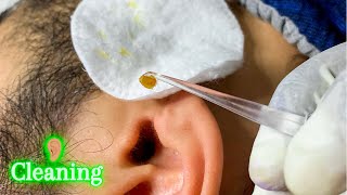 HUGE Ear Wax Removal  Cleaning Triggers  gentle wiping sleep sounds [upl. by Alegre]