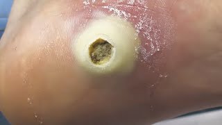 Big yellow hole on the feet  Much scary and horrible  pedicure treatment [upl. by Aibonez]