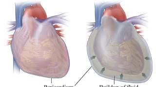 My Pericarditis or Heart Fluid Buildup I think it was caused by an infection It happened suddenly [upl. by Botzow966]