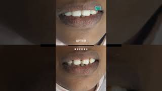 👰MARRIAGE  WEDDING TEETH GAP smiledesign dranbudentist [upl. by Iz]