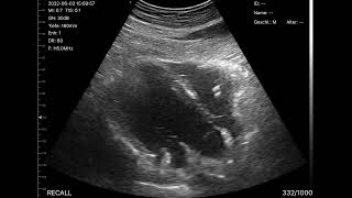 Heart ultrasound Subcostal coronal view [upl. by Lonergan]