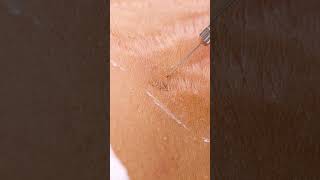 Up close view of how laser stretch mark removal works 😯 shorts [upl. by Euqina178]