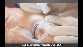 Blépharoplastie médicale sans chirurgie  PLEX’R paupières [upl. by Halak976]