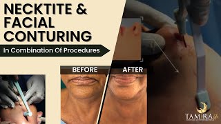 Neck Tightening with AccuTite l Facial Contouring l Accutite Procedure For Sagging Skin amp Wrinkles [upl. by Colette962]