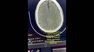 Subdural Hematoma SDH  slight head injury can lead hemorrhage hemorrhage headinjury ctbrain [upl. by Bluhm224]