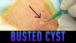 Excellent Epidermoid Cyst Excision [upl. by Ignatia793]