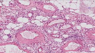 Angiomyolipoma  Kidney Histopathology [upl. by Llehcnom247]