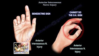 Anterior Interosseous Nerve Injury  Everything You Need To Know  Dr Nabil Ebraheim [upl. by Cattan]