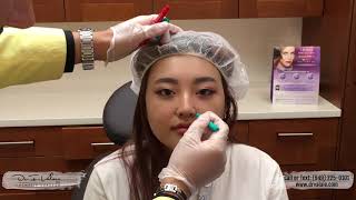 Gummy Smile Botox  Nose and Lips Improvement by injection only  Dr Valaie MD [upl. by Acirahs]