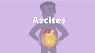 Cirrhosis – Ascites and pleural effusion [upl. by Atterbury]