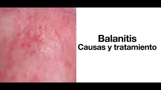 Balanitis Causas y tratamiento  Cura de la balanitis [upl. by Marks]