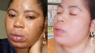 how I cleared my dark spots in 7days melano free cream olaybact BSC darkspot skincare [upl. by Burton263]