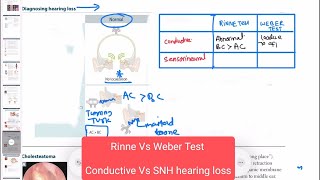 Conductive vs sensorineural hearing loss neurology 159 First Aid USMLE Step 1 in UrduHindi [upl. by Saree]