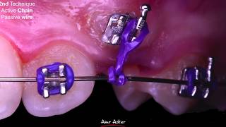 orthodontic canine exposure by electrocautery and bracket placement by Dr Amr Asker impacted [upl. by Annod]