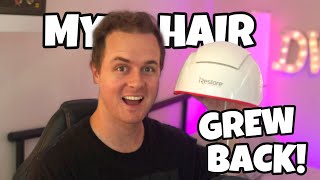 MY HAIR GREW BACK 6 months using iRestore Laser Hair Growth Therapy [upl. by Davilman]