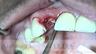 Atraumatic Extraction Socket preservation and temporization  Alvaro Ordoñez DDS [upl. by Aicertap310]