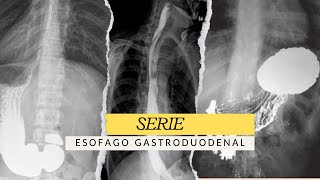 SERIE ESÓFAGO GASTRODUODENAL ESTUDIO RADIOLÓGICO radiologia radiology [upl. by Adlen]