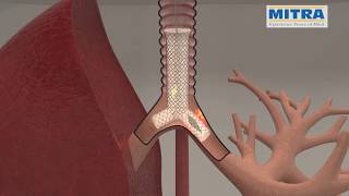 Tracheobronchial quotYquot stent MITRA OTTOMED ENDOSCOPY Interventional Pulmonology [upl. by Tterej]