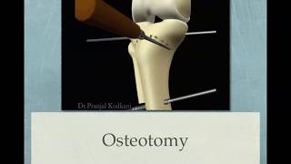 Dome osteotomy for knee osteoarthrosis [upl. by Anoi]