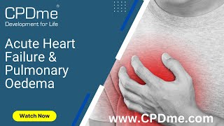 Acute Heart Failure amp Pulmonary Oedema Presented by Akash Doshi [upl. by Eemia]