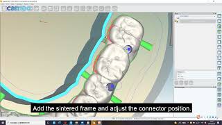 CMD 500 Software nestting guidance Video implanting Bridge Hyperdent [upl. by Assirahc571]