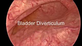 Bladder Diverticulum in Neurogenic Bladder [upl. by Lihp]