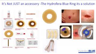 Ostomy Care with Hydrofera Blue Ostomy Ring [upl. by Alaaj]