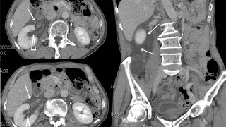 Moderate obstructive uropathy region due to renal calculus  cect abdomen and pelvis [upl. by Egroeg]