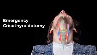 Performing an Emergent Cricothyroidotomy  MEDZCOOL [upl. by Suivat]