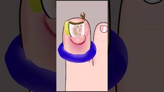 ASMR Ingrown Toenail Removal Treatment P1 asmr animation satisfying viral trending shorts [upl. by Enos]