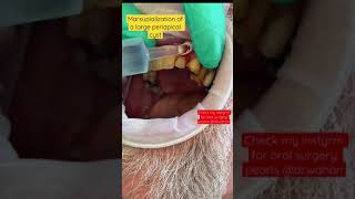 Marsupialization of a large radicular cyst [upl. by Enyamert]