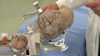 Skull Clamp Placement Parietal CraniotomyPin Placement Preview [upl. by Adal]