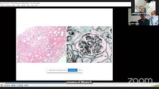 TMAThrombotic Microangiopathy in Renal Allograft Dr Pallav Gupta Lec 7 [upl. by Lidstone]