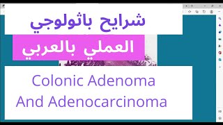 Colon histology  colonic adenocarcinoma  Tubulovillous adenoma low grade and high grade [upl. by Ariaec]