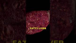 Understanding NAFLD NonAlcoholic Fatty Liver Disease Explained [upl. by Argile]