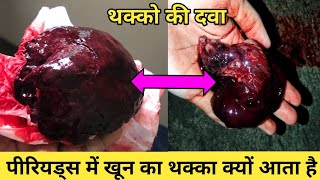 पीरियड में ब्लड का थक्का आना नार्मल है  Blood Clots During Periods  Period me blood clots aana [upl. by Eintruoc]