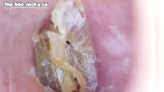 Ear Wax Removal 133 Thick Earwax Sticks To The Skin And Is Very Itchy  Ear Cleaning ASMR [upl. by Gwen]