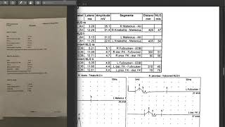 TUTORIAL  Auswertung elektrophysiologischer Befund SSEP sensible und motorische Neurographie [upl. by Babs]