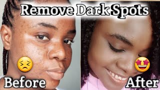 Dermatologist Recommended Best 3 Creams to remove Pimple Marks Acne Scars Dark Spots PIH [upl. by Dimo]