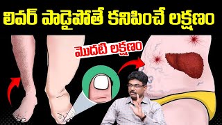 లివర్ పాడైపోతే కనిపించే మొదటి లక్షణం Liver Disease Symptoms Telugu  DrRajesh  I Dream [upl. by Tarfe]