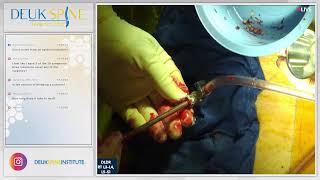 Endoscopic Debridement of Spinal Infection w Fusion  L3L4 L5S1 [upl. by Jenks465]