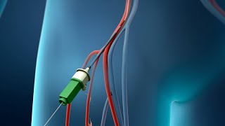 Coronary Angioplasty Femoral Access [upl. by Eatnwahs]